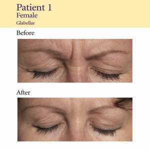 Botox glabella